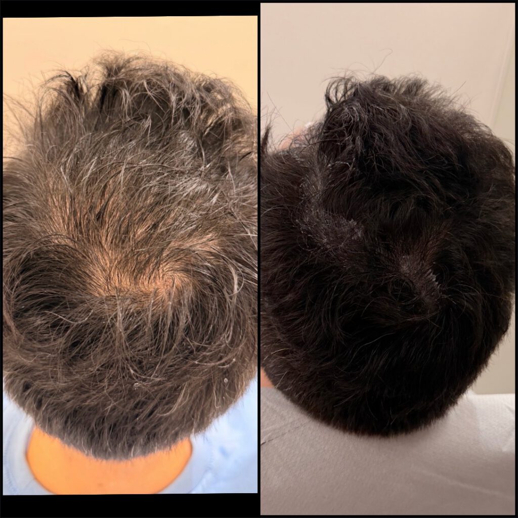 Hair Restoration Protocol