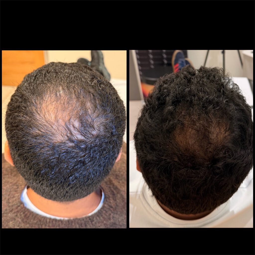 Advanced Hair Restoration Protocol