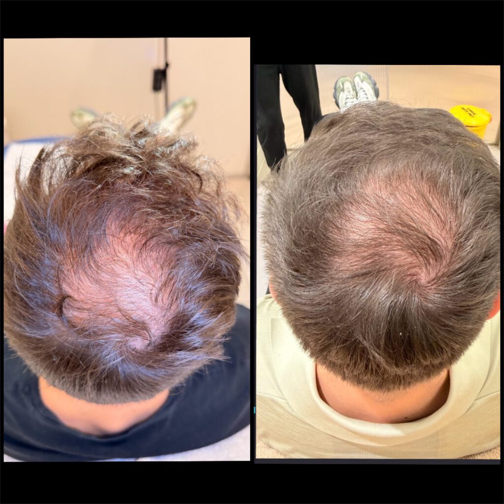 Hair Restoration Protocol