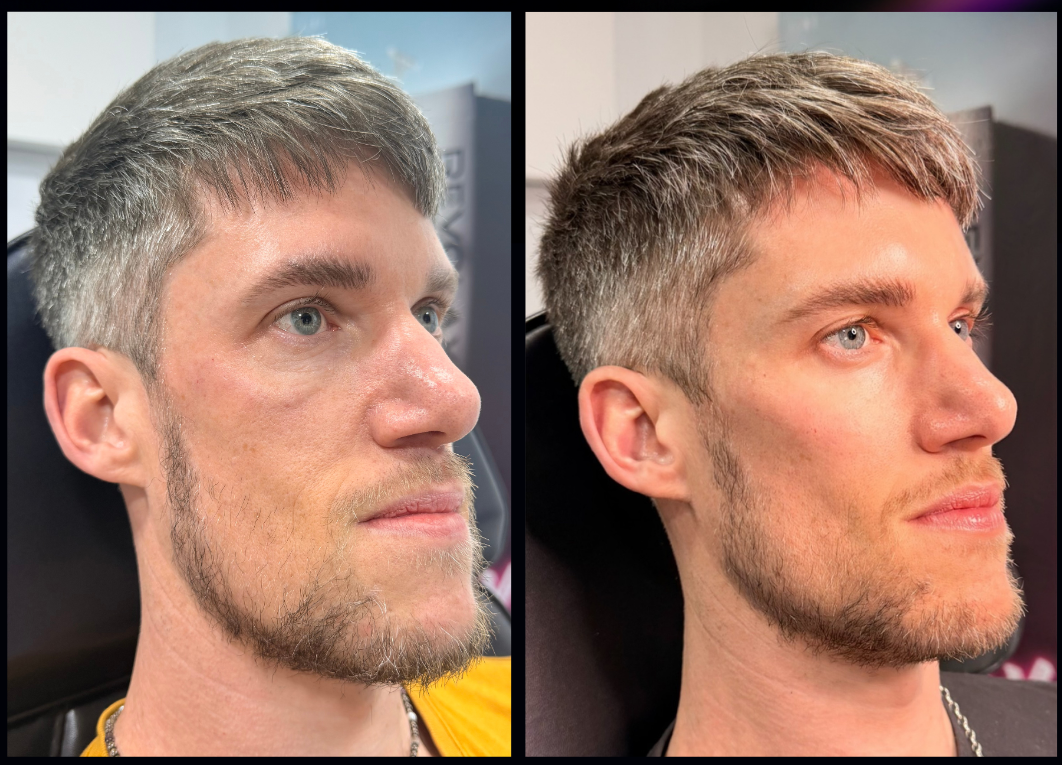 Before and After Male Facial Restorative Aesthetic Treatments - The Sana Clinic - Canary Wharf