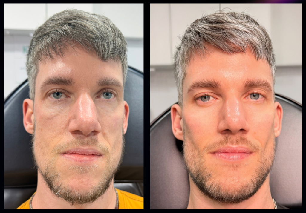 Full Facial Balancing And Restoration 