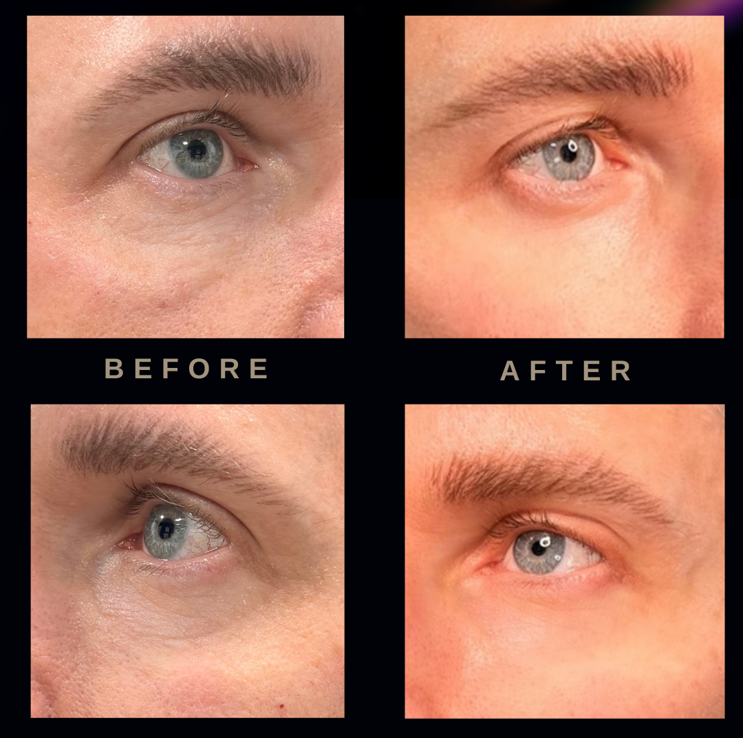 Before and After Under Eye Polynucleotide Treatments on a Male Patient - The Sana Clinic - Canary Wharf