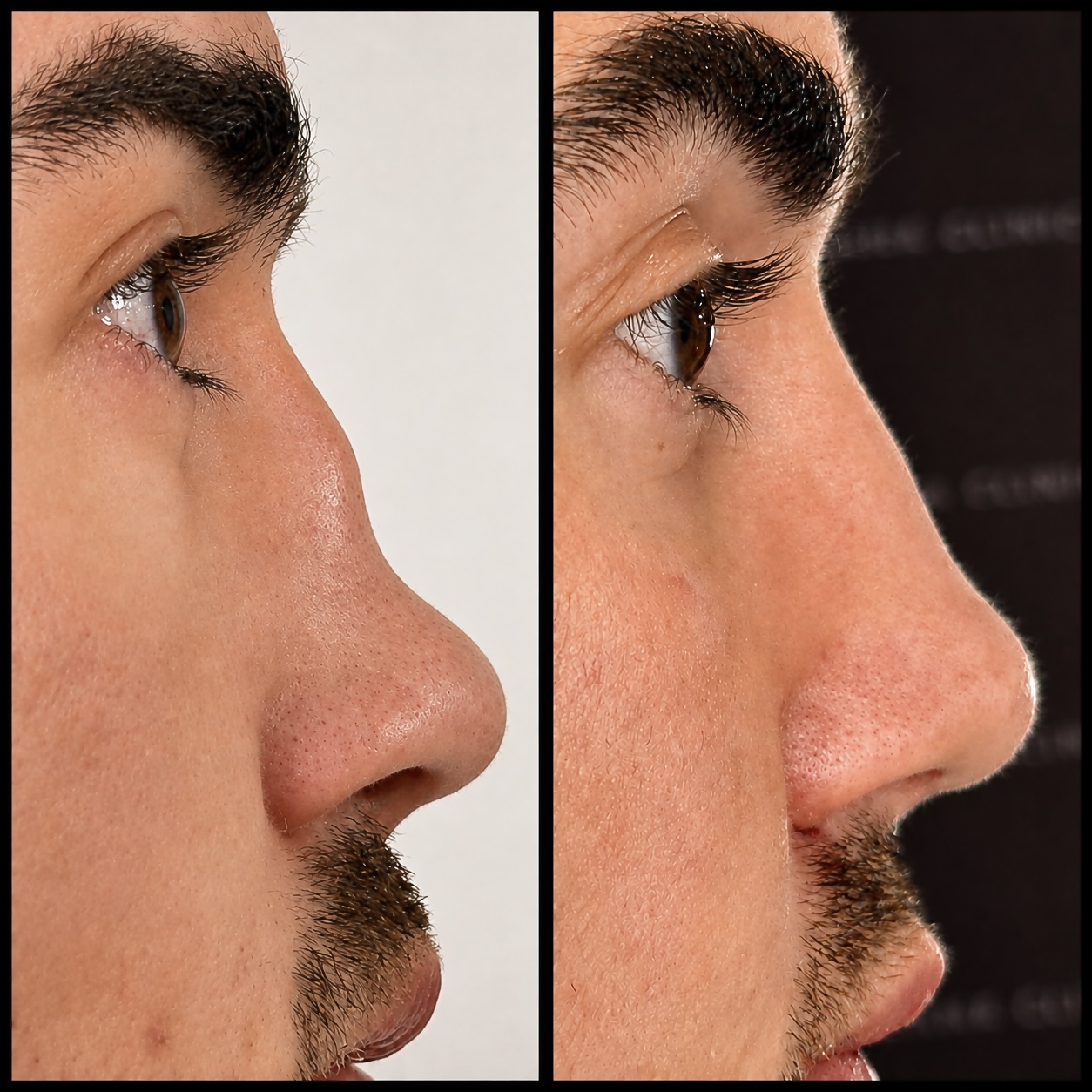 Before and after liquid rhinoplasty - The Sana Clinic - Dr Sana - Canary Wharf