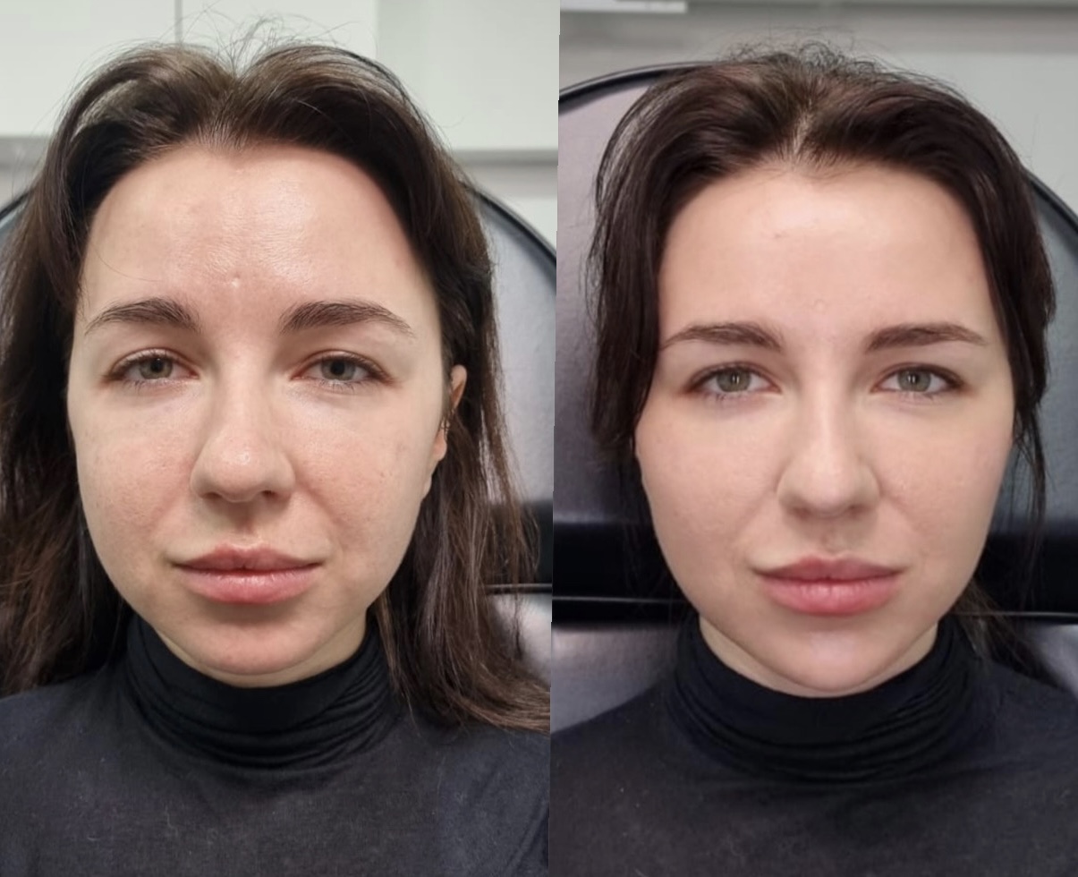 Before and After Facial Balancing Treatment Treatments - The Sana Clinic - Canary Wharf
