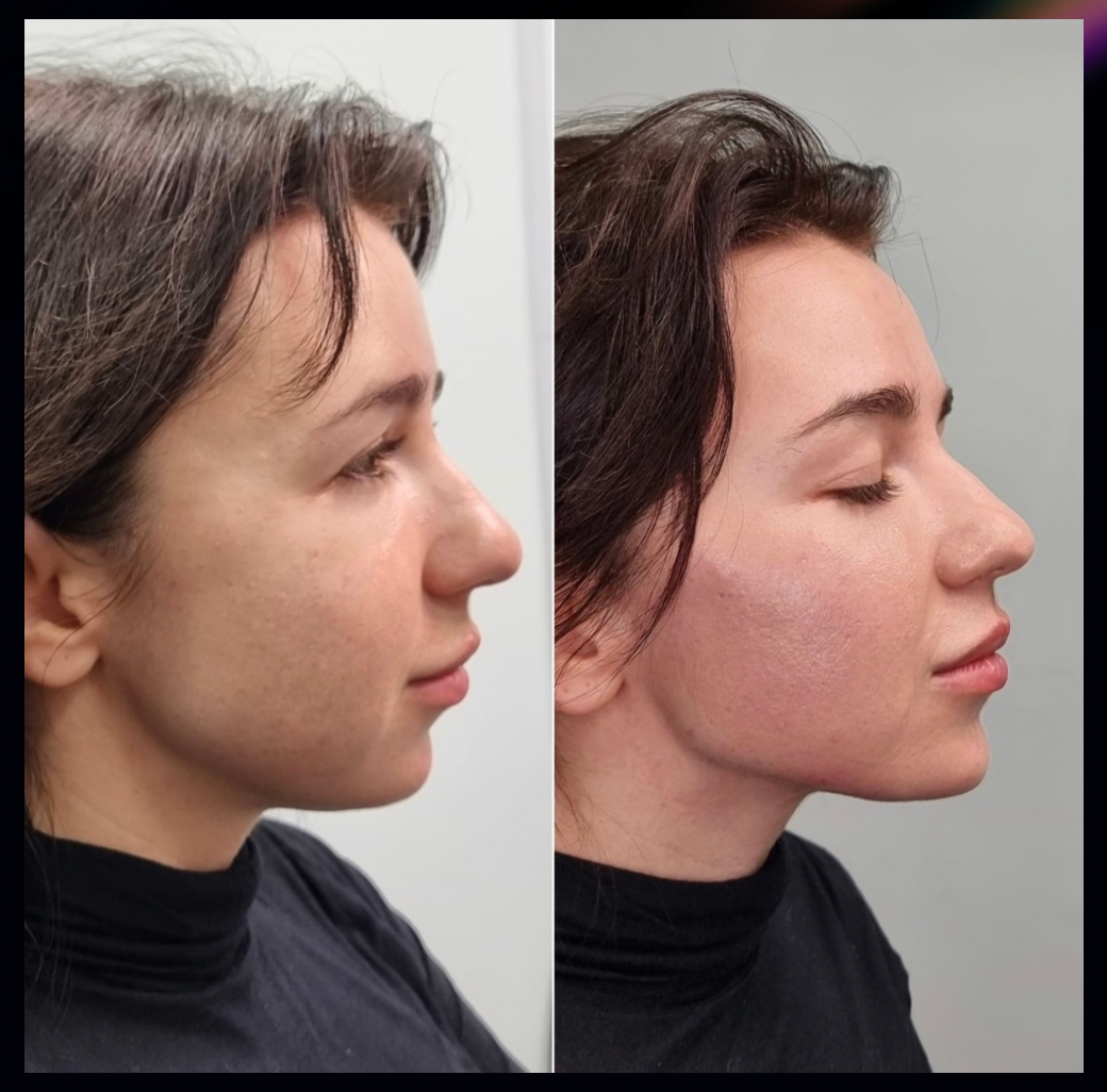 Before and After Facial Balancing Treatment Treatments - The Sana Clinic - Canary Wharf