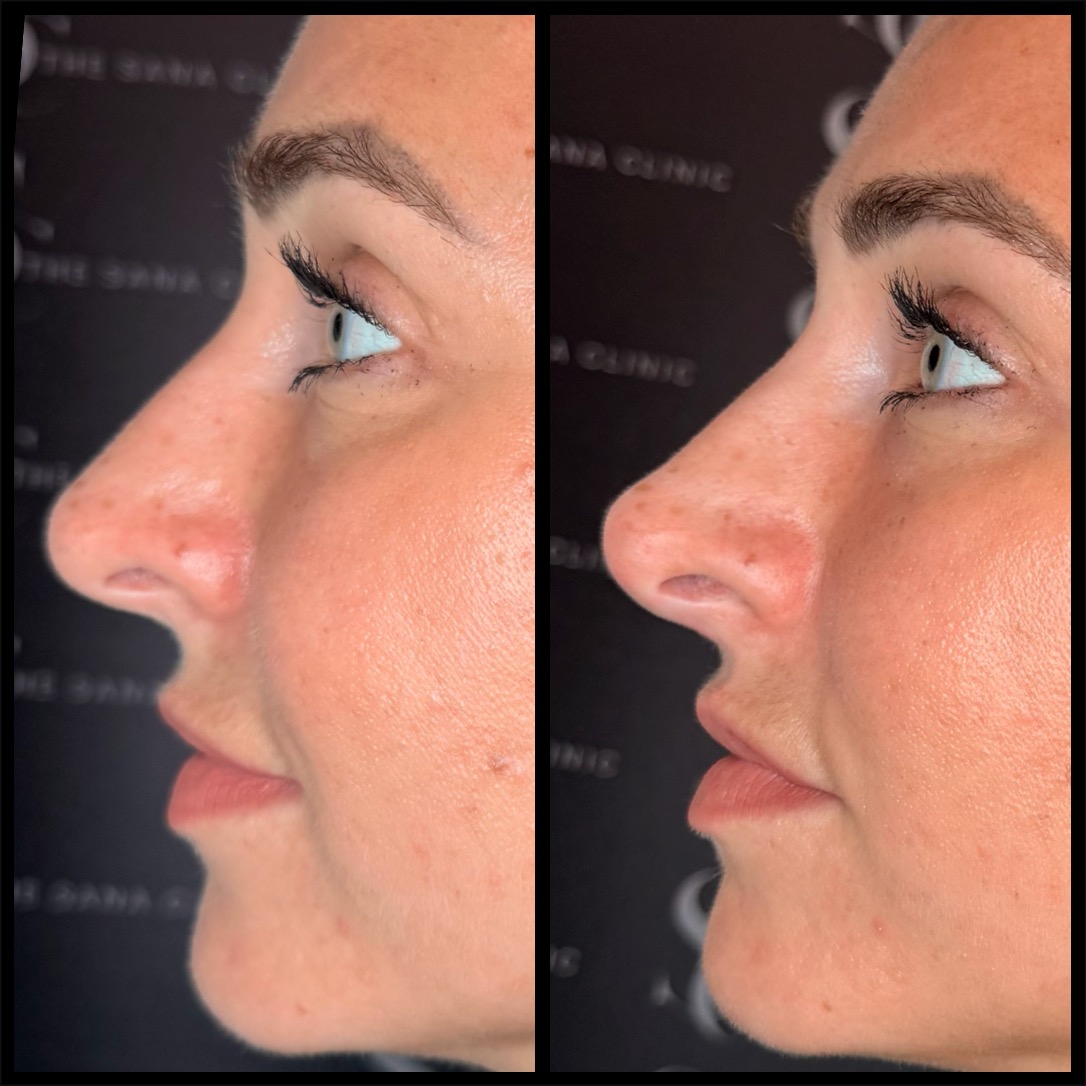 Before and After Picture for Liquid Rhinoplasty at The Sana Clinic - Canary Wharf