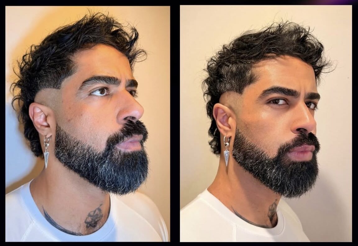 Before and After Cheek augmentation on male patient at The Sana Clinic - Canary Wharf