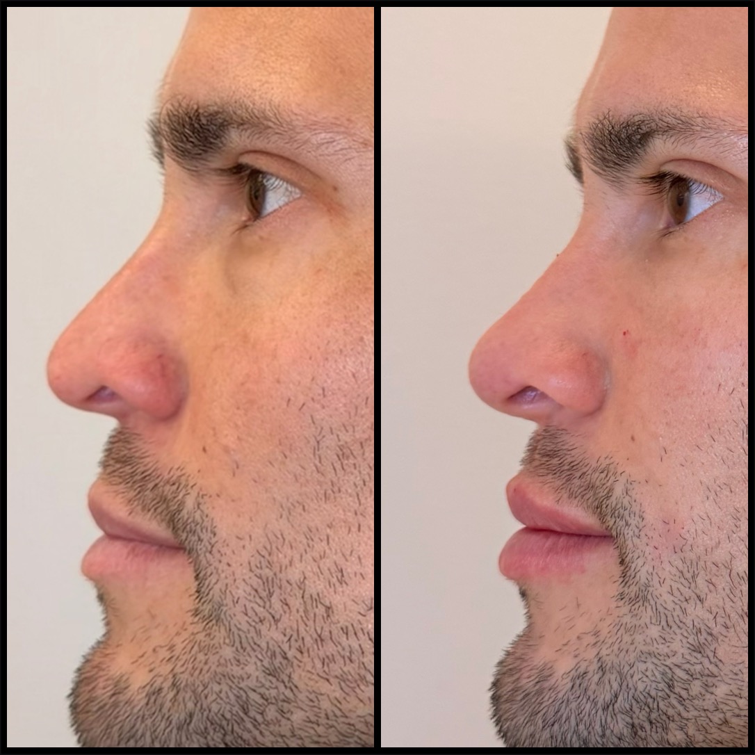 Before and After Picture for Liquid Rhinoplasty on a male at The Sana Clinic - Canary Wharf