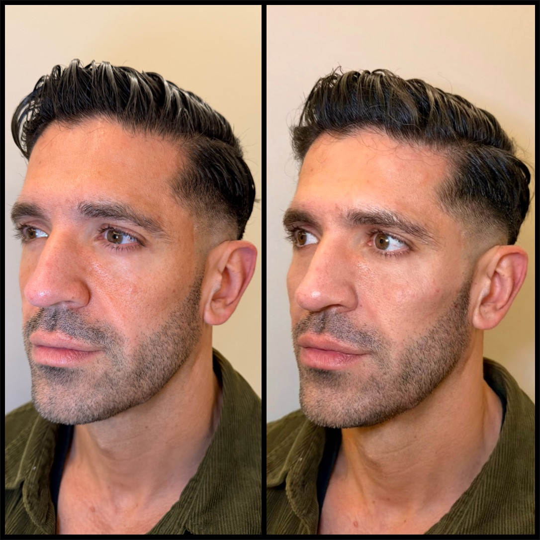 Before and After Full Facial Rejuvenation for Male Patient at The Sana Clinic - Canary Wharf