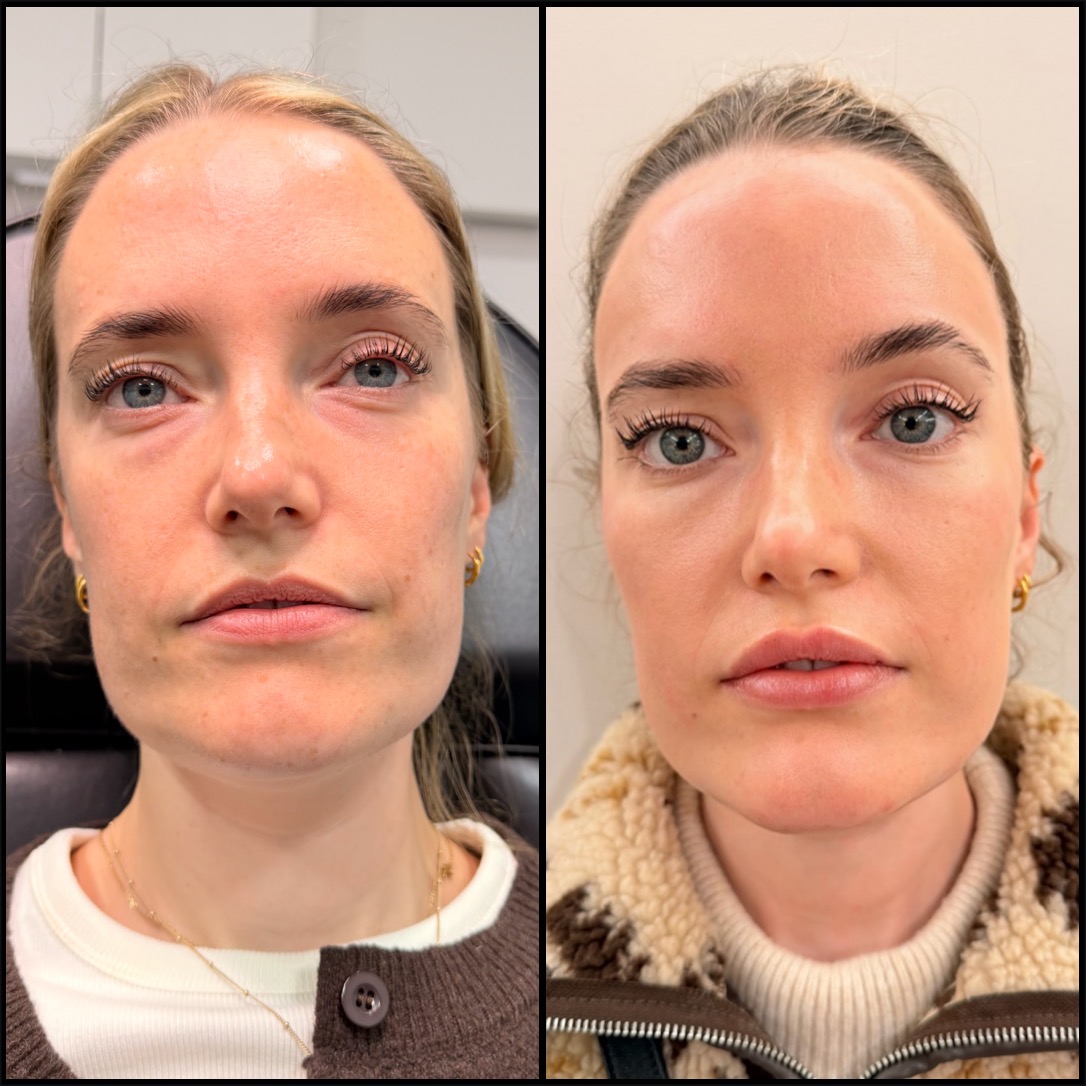 Before and After Full Facial Balancing for female Patient at The Sana Clinic - Canary Wharf