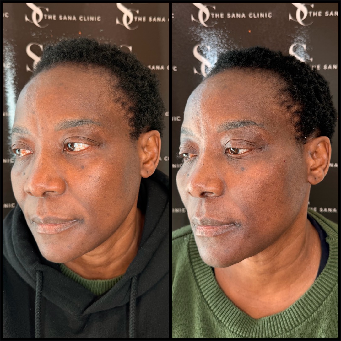 Before and After Full Facial Rejuvenation for female Patient at The Sana Clinic - Canary Wharf