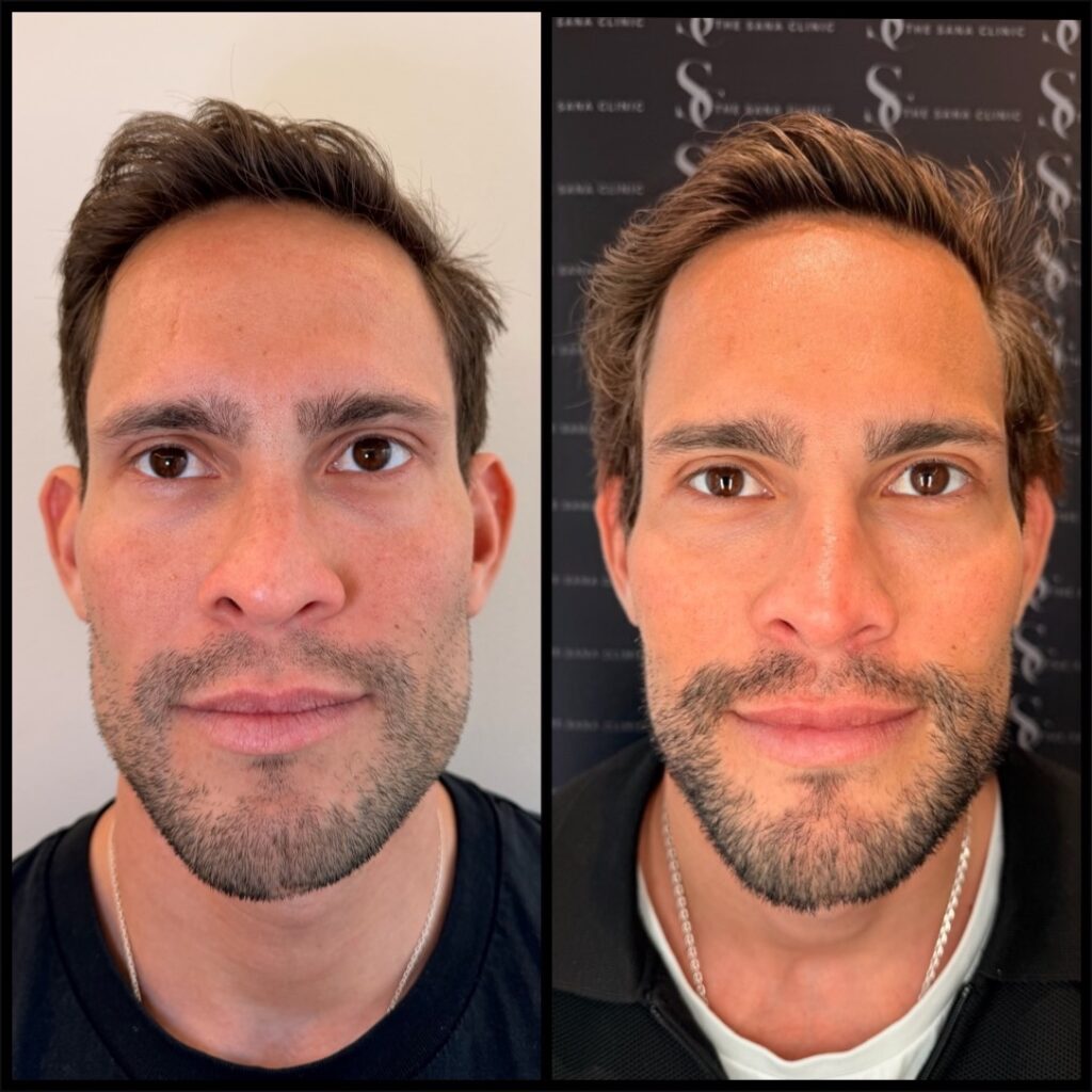 Full Facial Balancing 