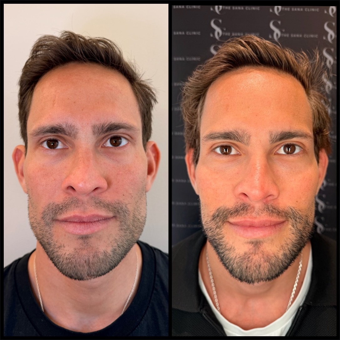 Before and After Full Facial Balancing for Male Patient at The Sana Clinic - Canary Wharf