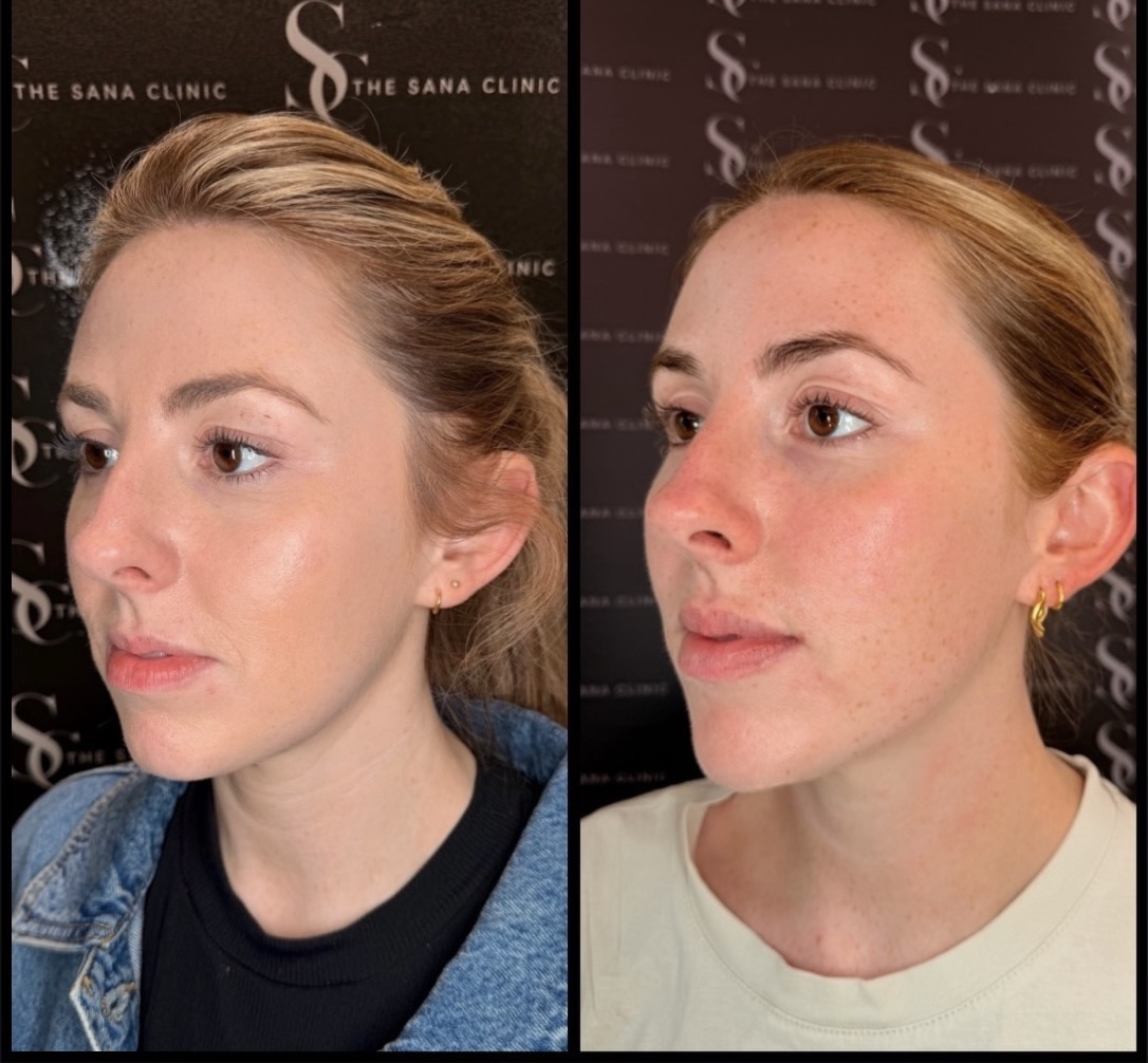 Before and After Full Facial Balancing for female Patient at The Sana Clinic - Canary Wharf