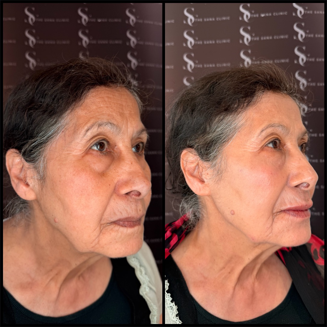 Before and After Full Face Restoration Aesthetics - The Sana Clinic - Canary Wharf