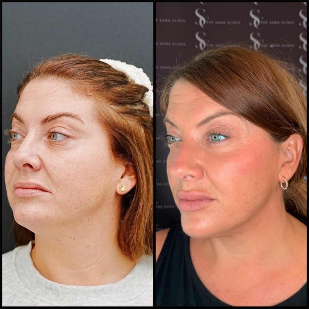 Full Facial Balancing 