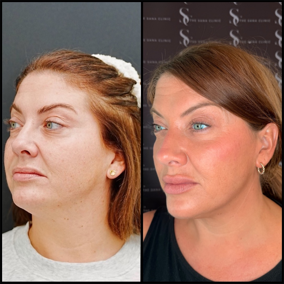 Before and After Full facial Balancing at The Sana Clinic - Canary Wharf