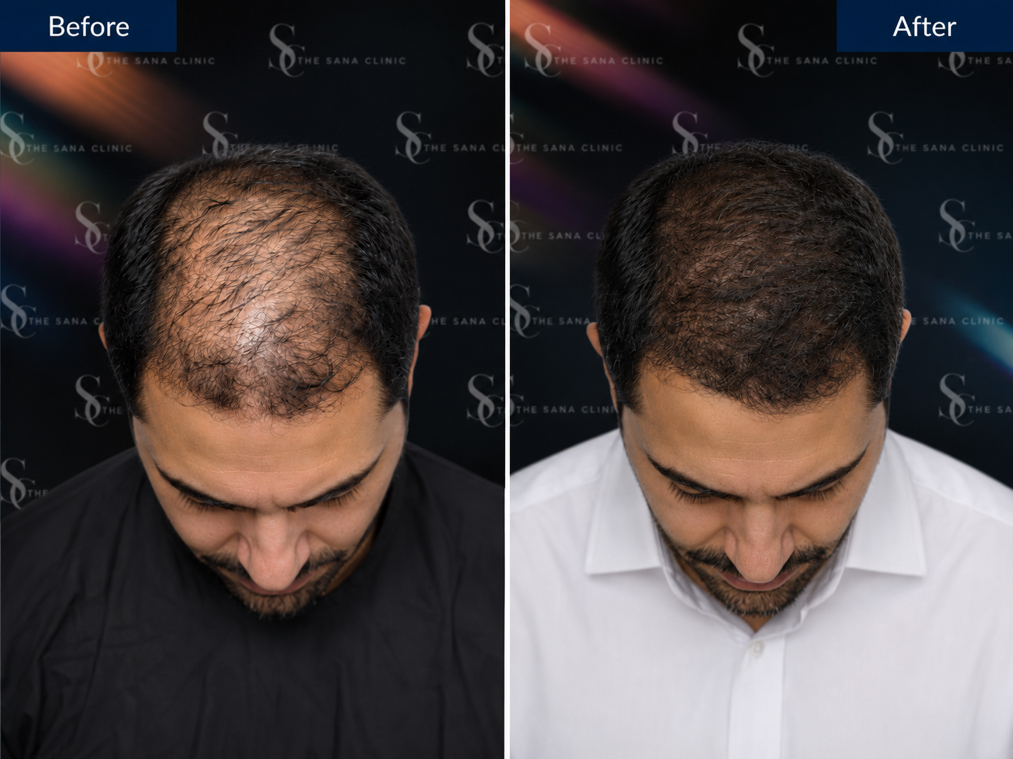 Before and After Hair Restoration for Male Pattern Balding - The Sana Clinic - Canary Wharf