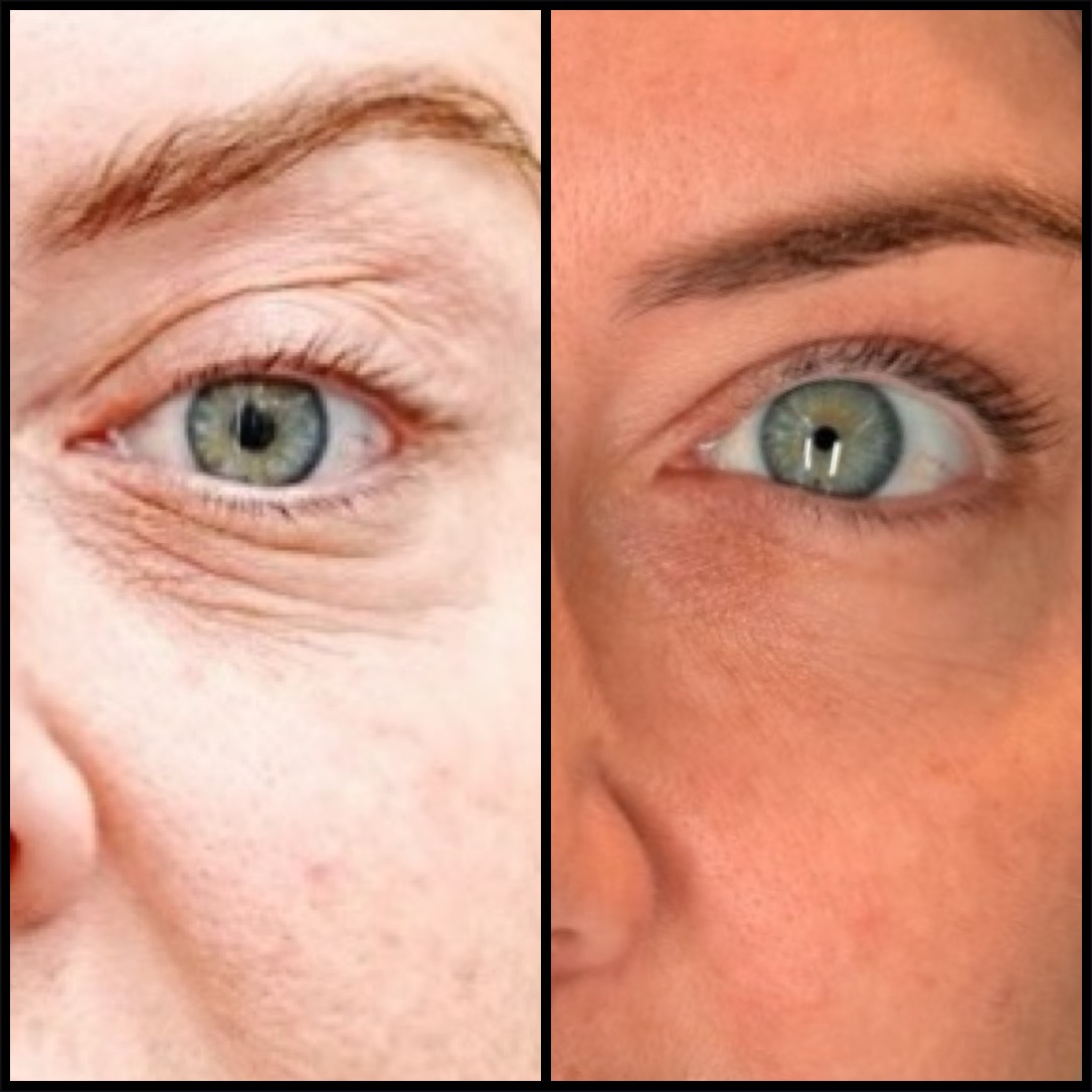 Before and After Under Eye Polynucleotide Treatments - The Sana Clinic - Canary Wharf